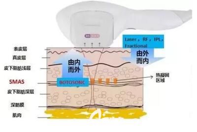 激光去红血丝价格？美容激光设备分析？(图1)