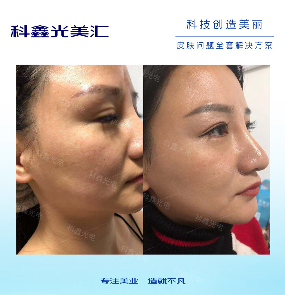 光子祛斑后怎样护理(图1)