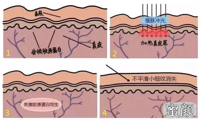 从小家电到第三类医疗器械:2026-2030年全球射频仪产业的合规重塑与格局重构(图1)