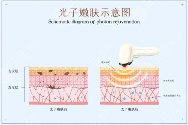 做光子嫩肤要多少钱第2018-11-29期-健康在线观看(图1)