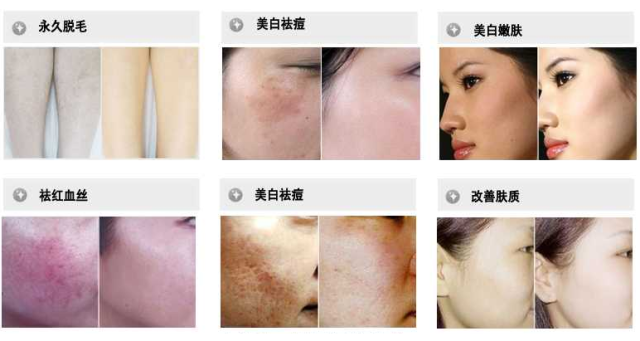 光子嫩肤有用吗(图1)